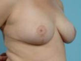 Patient # 62433 After Photo # 4